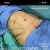 Abdominoplastia y dermolipectomia