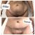 recomendable! abdominoplastia 360