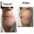 recomendable! abdominoplastia 360