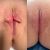 Labioplastía con la Dra Lambois - Super recomendada sin dolor.