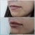 Relleno de labios con ácido hialurónico (Córdoba)