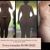 Dermolipectomia con Lipotransferencia Glutea