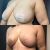 Mastopexia y abdominoplastia