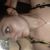 Rinoplastia con injerto