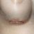 3 meses post operación - aumento mamario