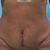 Dermolipectomia y miniliposuccion