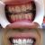 blanqueamiento-dental-laser-en-solo-1-hora-D_NQ_NP_5362-MLA437211521_7173-F