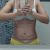 Abdominoplastia, excelente resultado