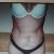 Abdominoplastia, excelente resultado