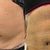 Abdominoplastia, liposución, aumento de mentón y lipoescultura