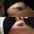 Aparición de hematoma 