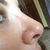 Rinoplastia: El día que me operé la nariz