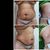 Mi abdominoplastia después de tanto  estoy feliz!!