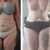 Abdominoplastia con liposuccion