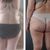 Abdominoplastia con liposuccion