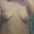 Mastopexia con aumento 560 cc