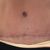 abdominoplastia e implante mamario me realice