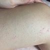 Granos en mis piernas