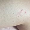 Granos en mis piernas