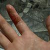 Agrietamiento, infeccion de la piel de la mano