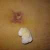 Necrosis luego de una abdominoplastia