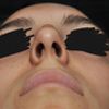 Colapso de ala nasal y ensanchamiento de columela consecuencia de rinoplastia