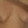 Mamas tuberosas - sin implantes?