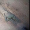 Labioplastia SOY CANDIDATA?