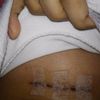 Que debo llevar a la cirugia de mamas?
