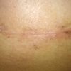Que debo llevar a la cirugia de mamas?
