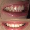 Experiencias y precios de ortodoncia Damon / alineadores transparentes