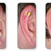 OTOPLASTIA:  Ear Fold u OtoFast 