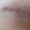 Infiltración fortcinolona 40 mg