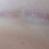 Infiltración fortcinolona 40 mg