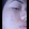 Como eliminar cicatrices de acne