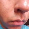 Cicatrices de acne en la nariz