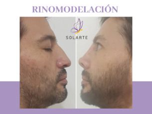 Rinomodelación Sin Cirugía $25.000
