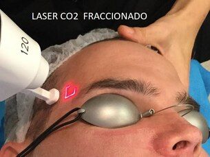 Laser CO2 Facial Fraccionado
