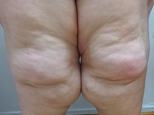 LIPEDEMA DE RODILLA