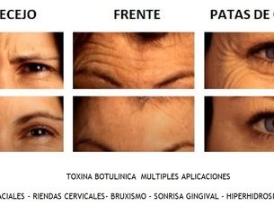 Botox facial - bruxismo - hiperhidrosis