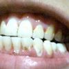 Carillas dentales después de la Ortodoncia - 1357