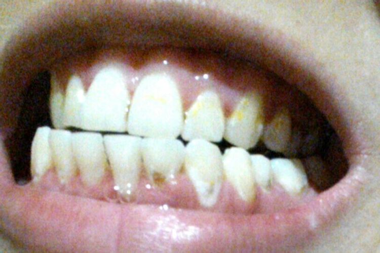 Carillas dentales después de la Ortodoncia