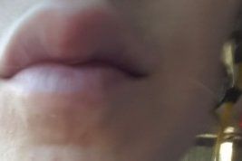Extraccion de metacrilato en labios