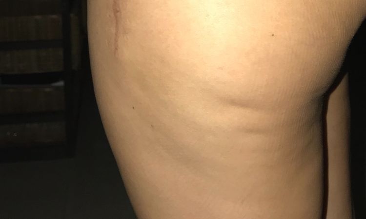 Mini lipo láser MELA - 4588