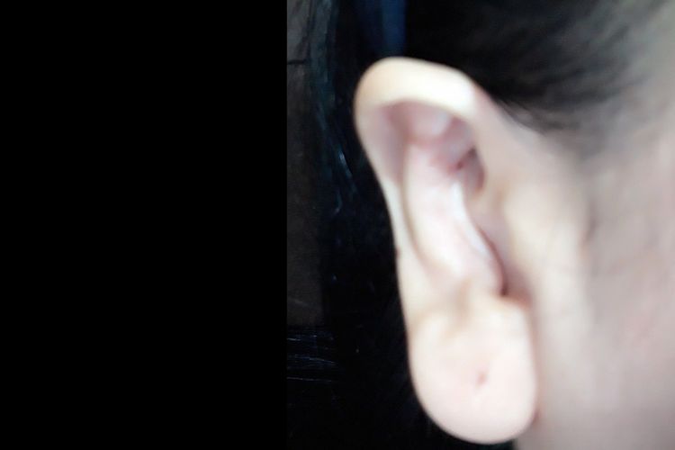 Otoplastia problemas con la piel
