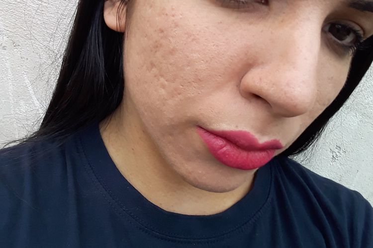 Como sacar cicatrices de acne?