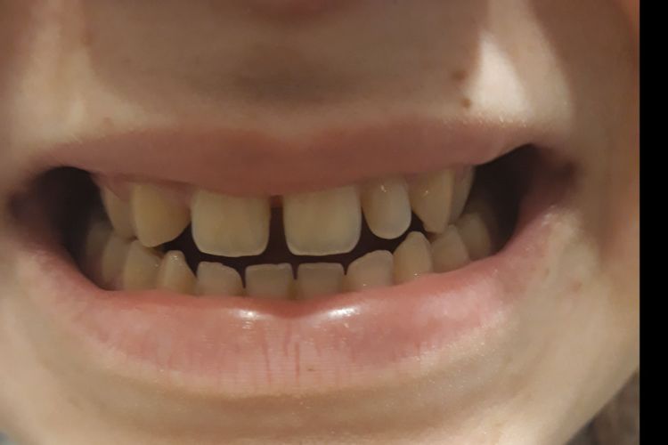Arreglo agenesia + diastema.