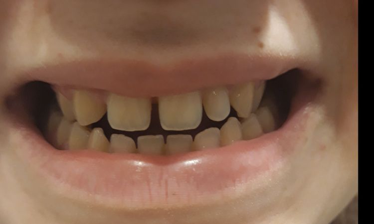 Arreglo agenesia + diastema. - 5277