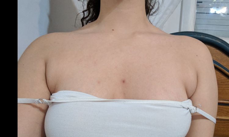 liposucción en las axilas - 5388