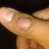 Callos en los nudillos de la mano